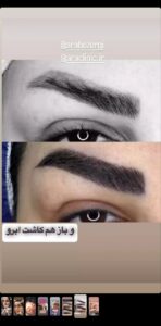 نمونه کاشت مو (كلينيك كاشت مو آرا)