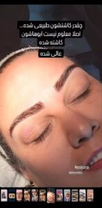 نمونه کاشت مو (كلينيك كاشت مو آرا)