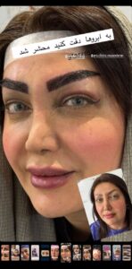 نمونه کاشت مو (كلينيك كاشت مو آرا)