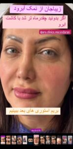 نمونه کاشت مو (كلينيك كاشت مو آرا)