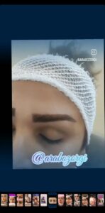 نمونه کاشت مو (كلينيك كاشت مو آرا)