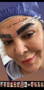 نمونه کاشت مو (كلينيك كاشت مو آرا)