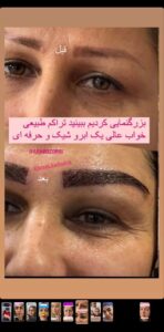 نمونه کاشت مو (كلينيك كاشت مو آرا)