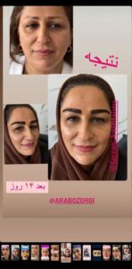 نمونه کاشت مو (كلينيك كاشت مو آرا)