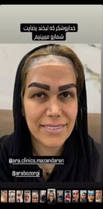 نمونه کاشت مو (كلينيك كاشت مو آرا)