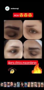 نمونه کاشت مو (كلينيك كاشت مو آرا)