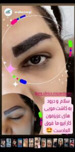 نمونه کاشت مو (كلينيك كاشت مو آرا)