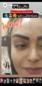 نمونه کاشت مو (كلينيك كاشت مو آرا)