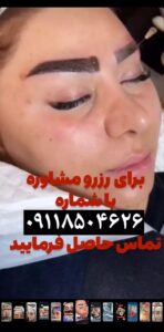 نمونه کاشت مو (كلينيك كاشت مو آرا)