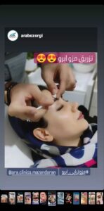 نمونه کاشت مو (كلينيك كاشت مو آرا)