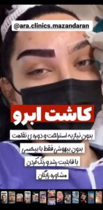 نمونه کاشت مو (كلينيك كاشت مو آرا)