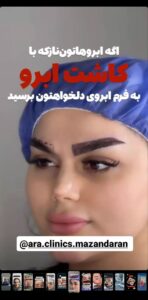 نمونه کاشت مو (كلينيك كاشت مو آرا)