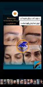 نمونه کاشت مو (كلينيك كاشت مو آرا)