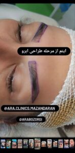 نمونه کاشت مو (كلينيك كاشت مو آرا)