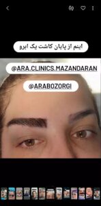 نمونه کاشت مو (كلينيك كاشت مو آرا)