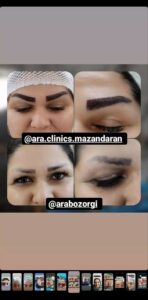 نمونه کاشت مو (كلينيك كاشت مو آرا)