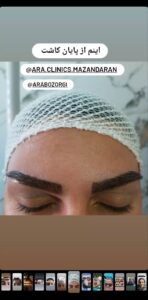 نمونه کاشت مو (كلينيك كاشت مو آرا)