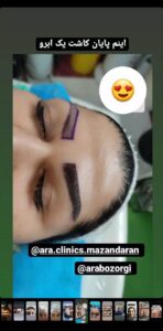 نمونه کاشت مو (كلينيك كاشت مو آرا)