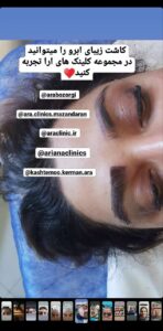 نمونه کاشت مو (كلينيك كاشت مو آرا)