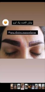 نمونه کاشت مو (كلينيك كاشت مو آرا)