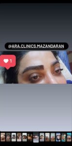 نمونه کاشت مو (كلينيك كاشت مو آرا)