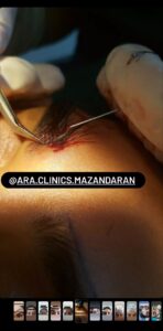 نمونه کاشت مو (كلينيك كاشت مو آرا)