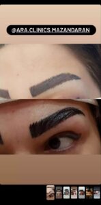 نمونه کاشت مو (كلينيك كاشت مو آرا)