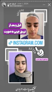نمونه کار تزریق چربی دکتر رحمت پور رکنی در ساری