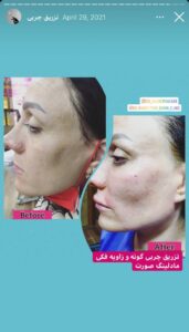 نمونه کار تزریق چربی دکتر رحمت پور رکنی در ساری