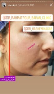 نمونه کار تزریق چربی دکتر رحمت پور رکنی در ساری