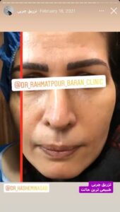 نمونه کار تزریق چربی دکتر رحمت پور رکنی در ساری