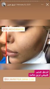 نمونه کار تزریق چربی دکتر رحمت پور رکنی در ساری