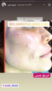 نمونه کار تزریق چربی دکتر رحمت پور رکنی در ساری