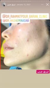 نمونه کار تزریق چربی دکتر رحمت پور رکنی در ساری