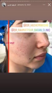 نمونه کار تزریق چربی دکتر رحمت پور رکنی در ساری