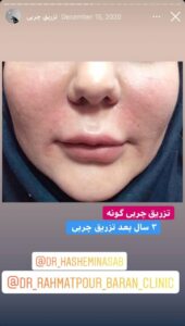 نمونه کار تزریق چربی دکتر رحمت پور رکنی در ساری