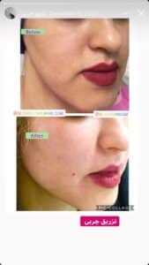 نمونه کار تزریق چربی دکتر رحمت پور رکنی در ساری