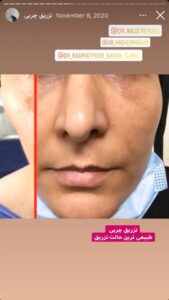 نمونه کار تزریق چربی دکتر رحمت پور رکنی در ساری