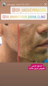 نمونه کار تزریق چربی دکتر رحمت پور رکنی در ساری