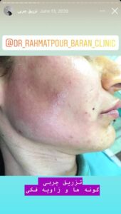 نمونه کار تزریق چربی دکتر رحمت پور رکنی در ساری