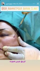نمونه کار تزریق چربی دکتر رحمت پور رکنی در ساری
