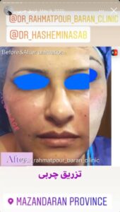 نمونه کار تزریق چربی دکتر رحمت پور رکنی در ساری