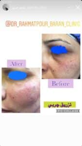 نمونه کار تزریق چربی دکتر رحمت پور رکنی در ساری