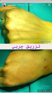نمونه کار تزریق چربی دکتر رحمت پور رکنی در ساری