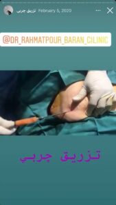 نمونه کار تزریق چربی دکتر رحمت پور رکنی در ساری