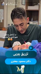 نمونه کار تزریق چربی کلینیک رز سیفد در ساری