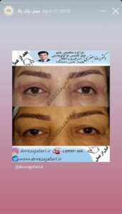 نمونه کار بلفاروپلاستی دکتر جعفری در ساری