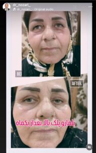 نمونه کار بلفارو دکتر نوذری در ساری