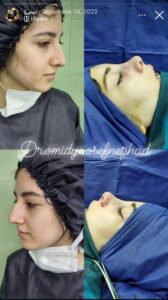 نمونه کار جراحی بینی (رینوپلاستی ) دکتر یوسف نژاد در ساری