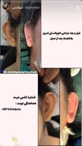 نمونه کار اتوپلاستی (جراحی گوش) دکتر یوسف نژاد در ساری